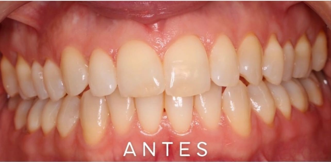 Dientes antes del blanqueamiento dental