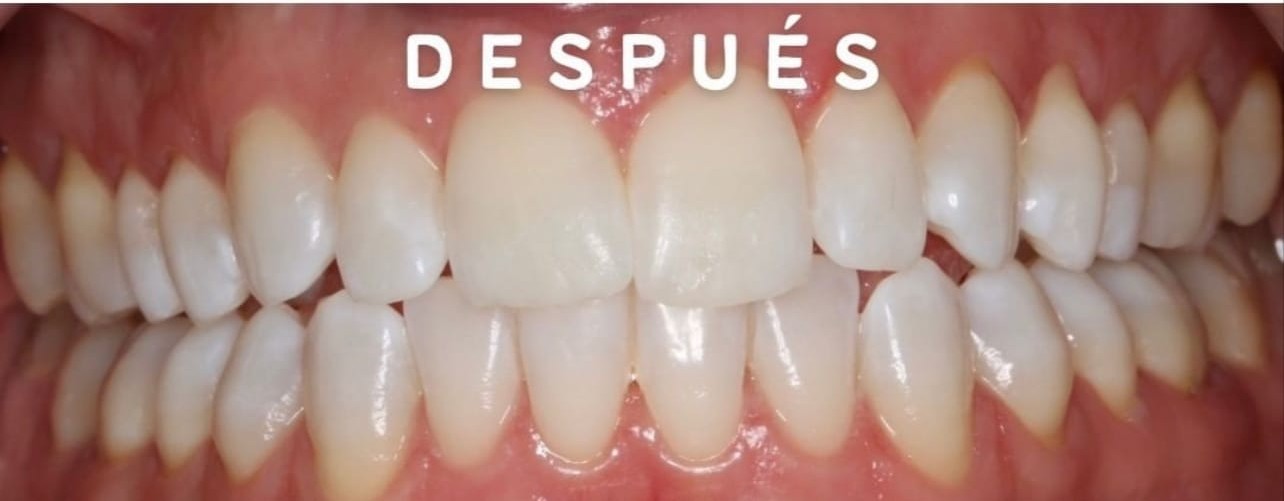 Dientes después del blanqueamiento dental