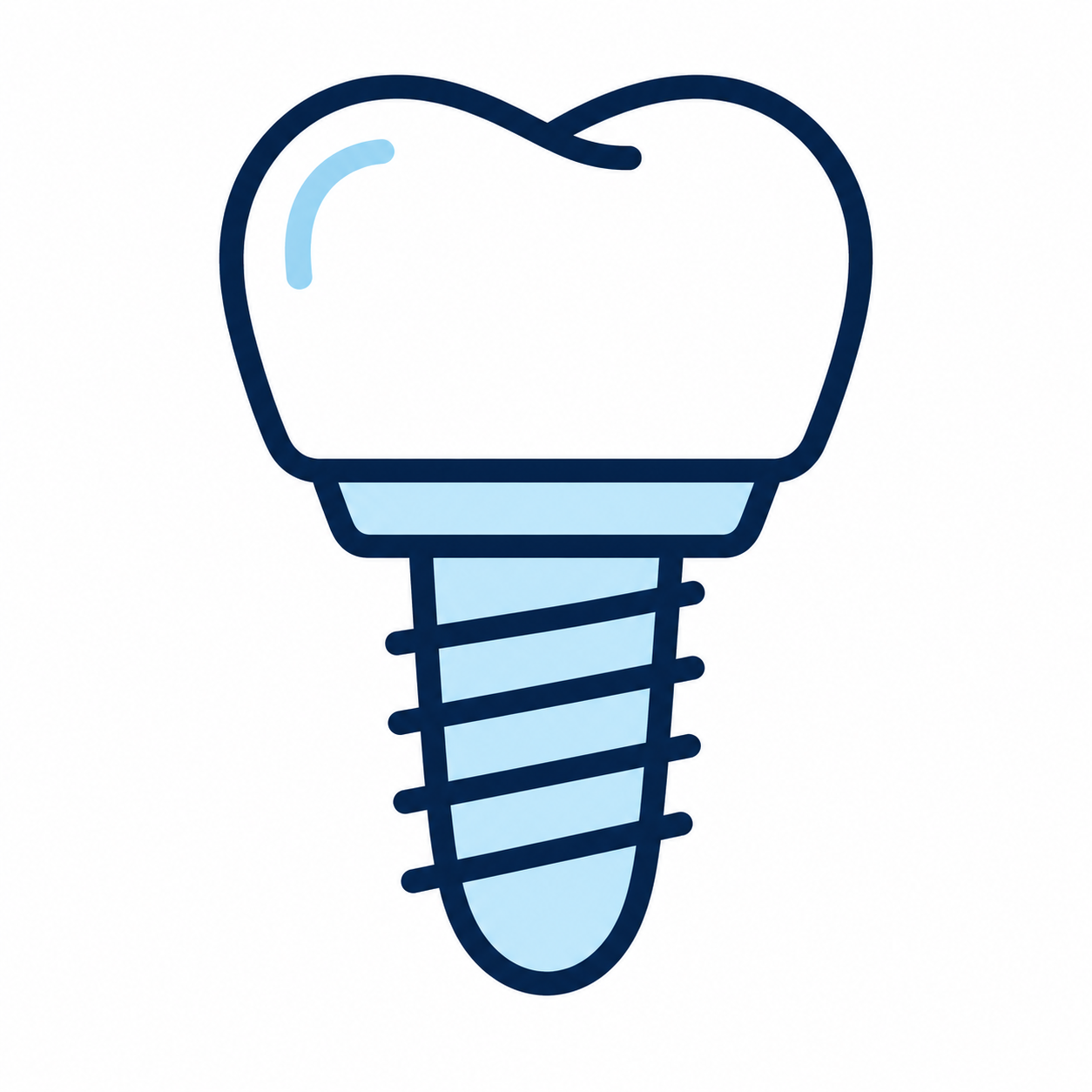 Ilustración de implante dental – servicio ofrecido en Naucalpan