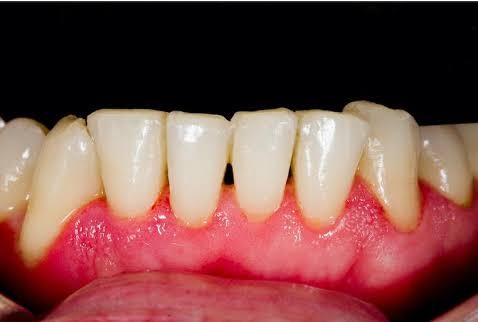Resultado real de limpieza dental profesional - dientes blancos y sanos