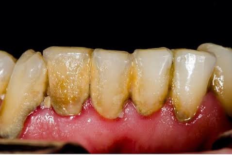 Dientes antes de la limpieza dental profesional en Consultorio Dental Nuevo Amanecer Naucalpan