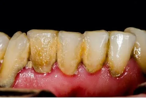 Dientes antes de la limpieza dental profesional en Consultorio Dental Nuevo Amanecer Naucalpan