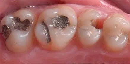 Dientes antes del tratamiento con resinas
