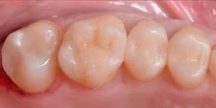 Dientes después del tratamiento con resinas